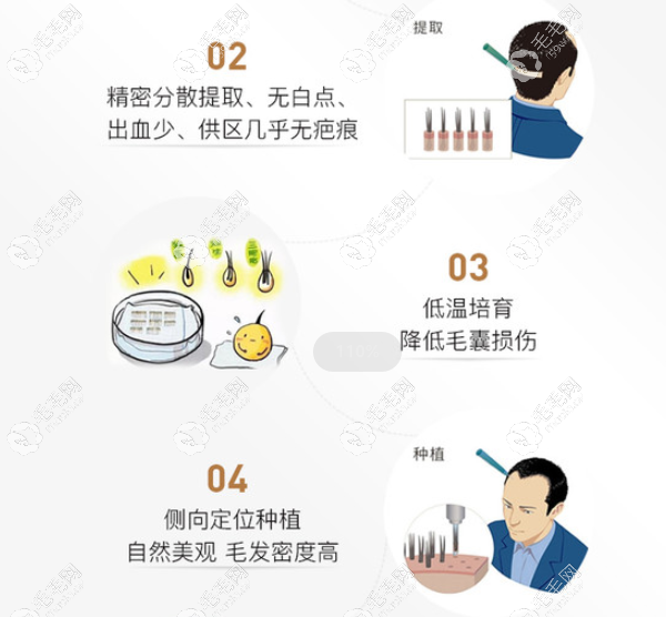 UST精微植发技术的优势