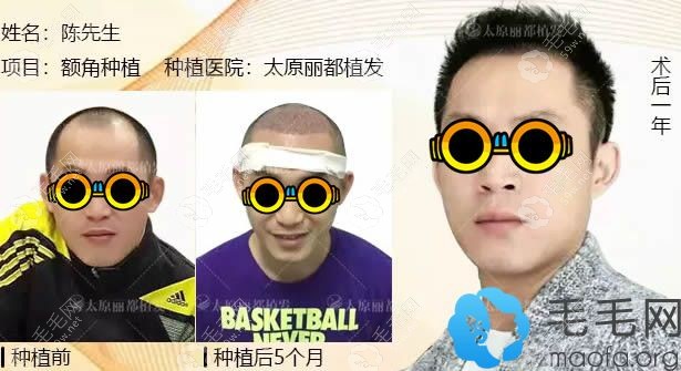 太原丽都朱世伟医生m型额角植发一年后效果图
