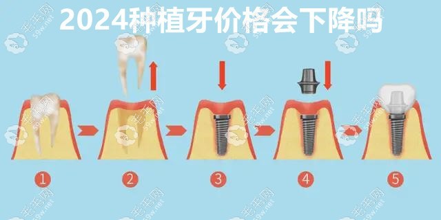 2024种植牙价格 毛毛网