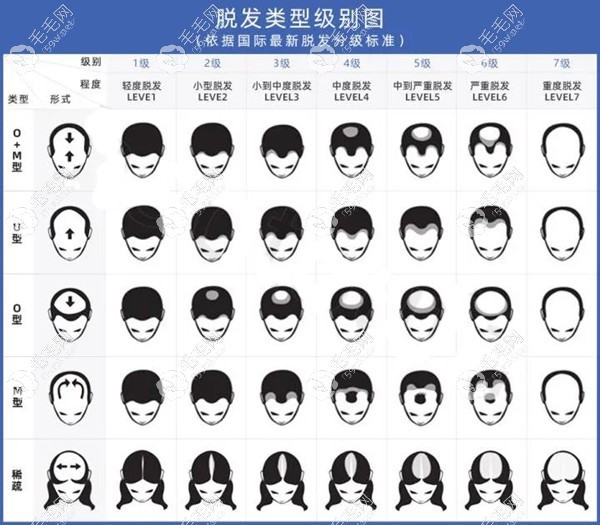 怎么样才算秃顶呢？可以看脱发等级图