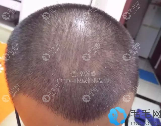 碧蓮盛植發(fā)手術(shù)1個半月效果