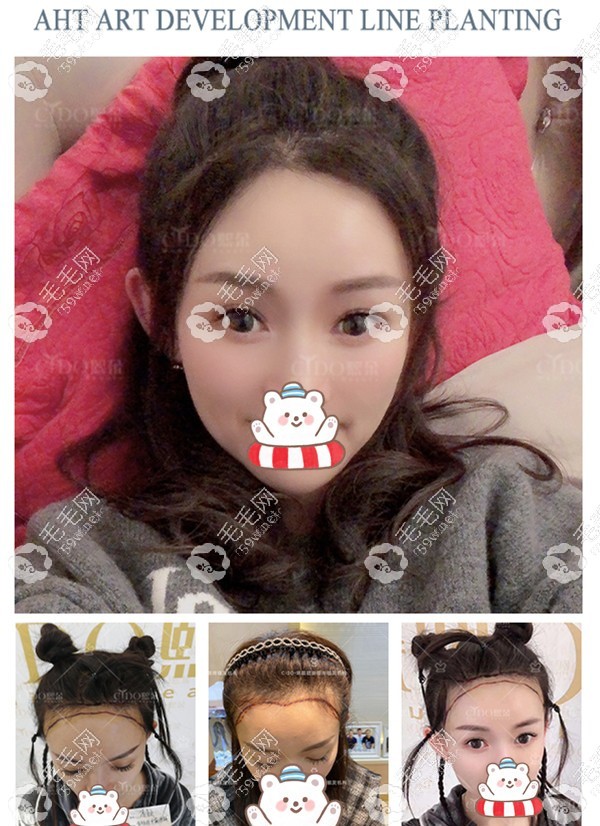 熙朵AHT发际线种植案例效果图