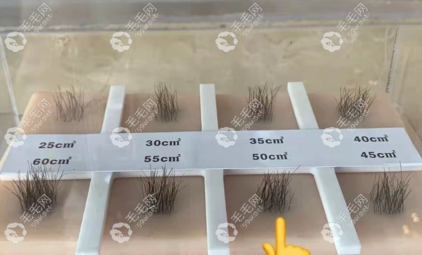 毛囊移植种植密度图