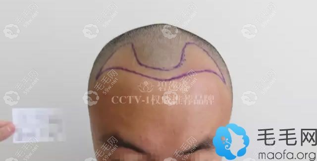 M型發(fā)際線植發(fā)手術(shù)方案圖