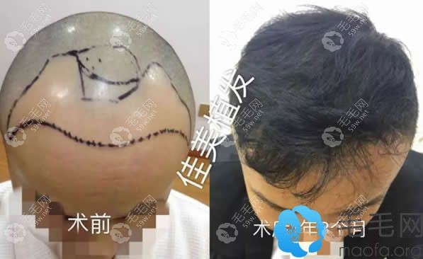 M字脱发在南昌佳美植发一年3个月的效果对比图