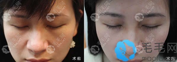佳美种植睫毛120单位的术后效果对比图