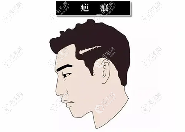 张家界疤痕植发价格明细
