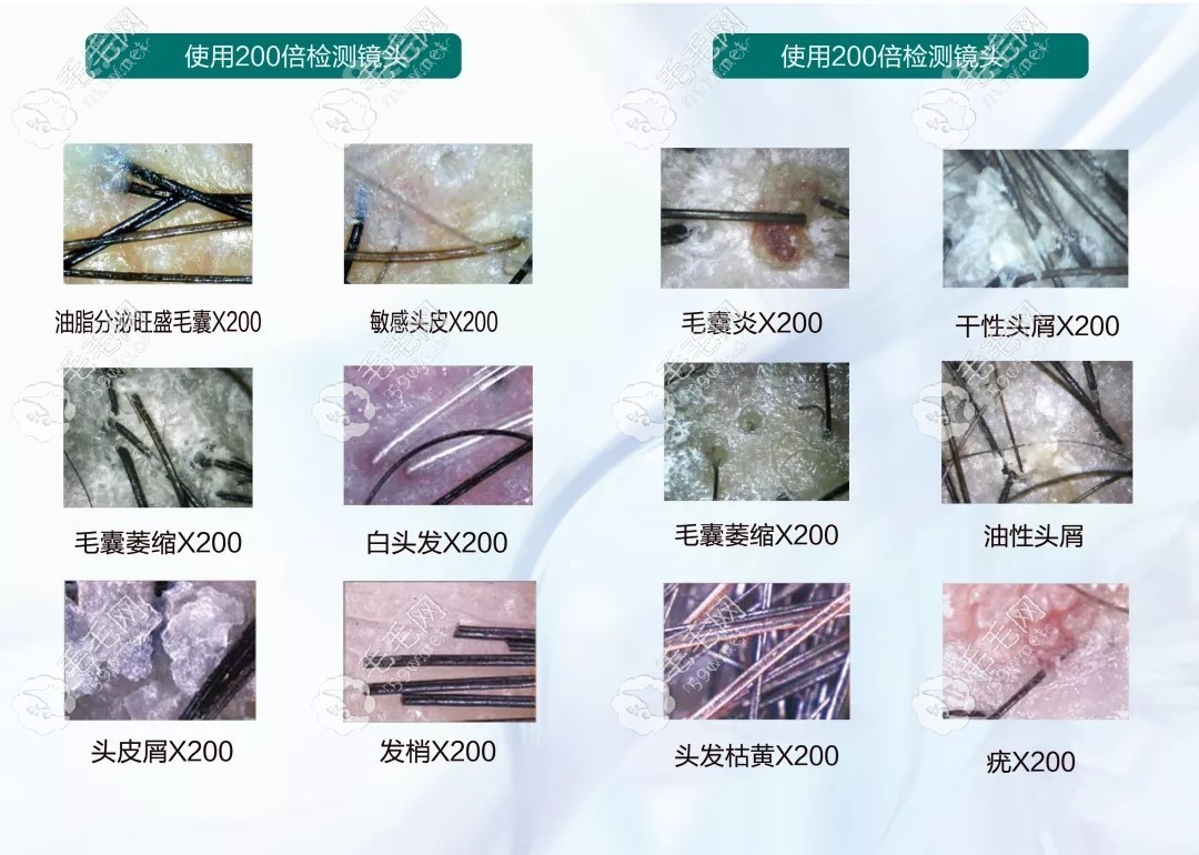 这就是毛囊检测