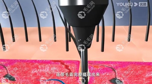 不剃发植发取毛囊的方式