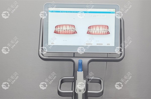 隐形正畸方案模拟图59w.net