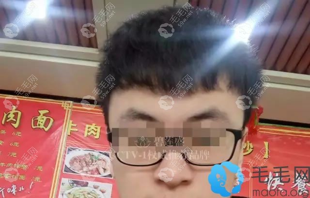 大學生在碧蓮盛植發(fā)第8個月效果
