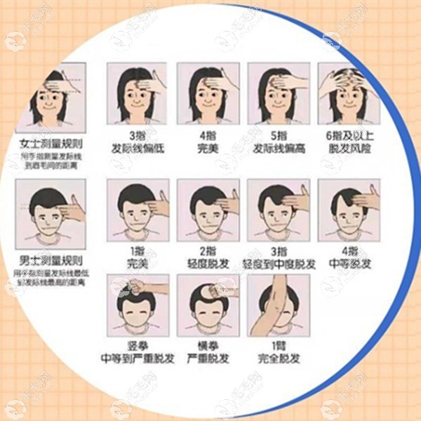 四指判断发际线是否后移的方法