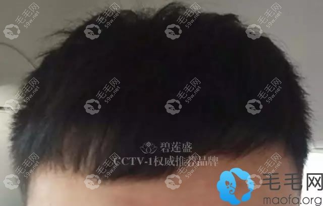 碧蓮盛種植發(fā)際線7個月圖片