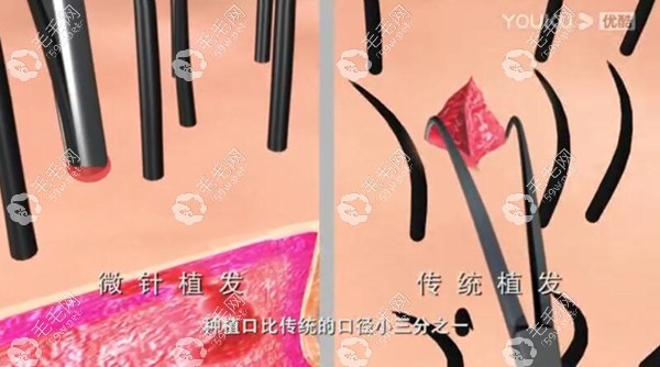 不剃发植发和传统植发的区别