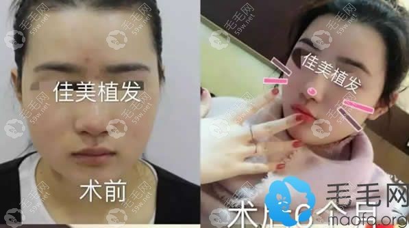 南昌佳美女生种植发际线效果案例