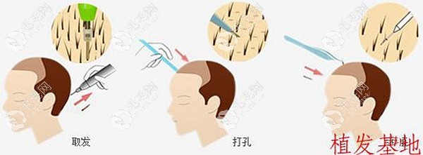 张家界做毛发移植手术