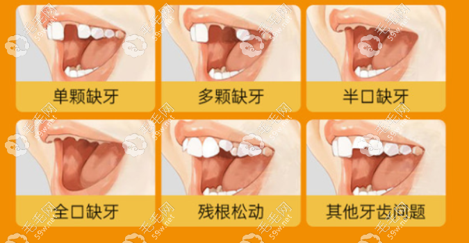 种植牙适合哪些人