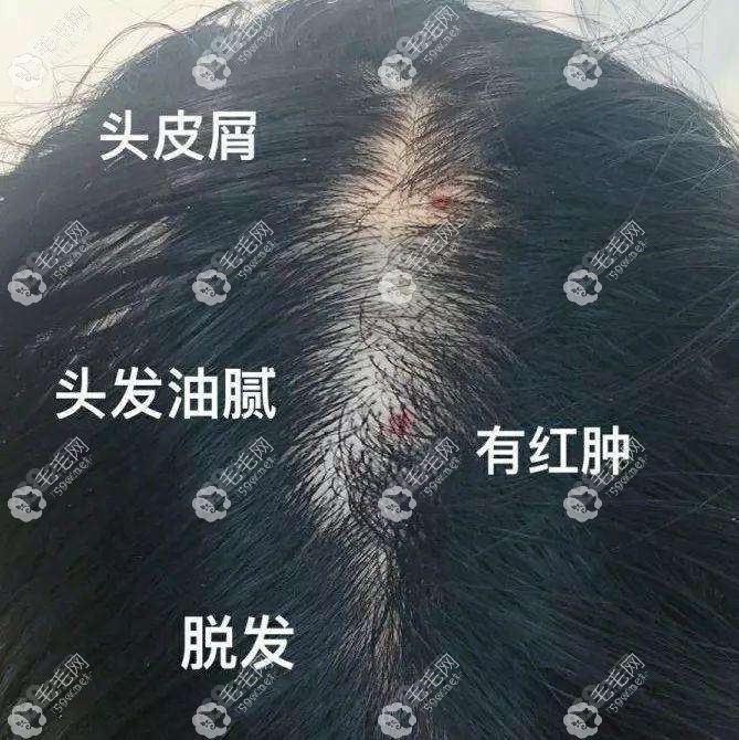 观察脱发区域的头皮
