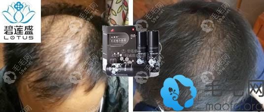 米诺地尔生发案例对比图