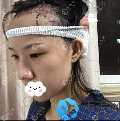 上海华美黄兴勇发际线移植术后即刻