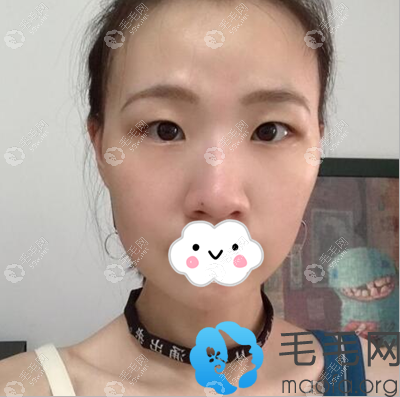 发际线种植术前照片