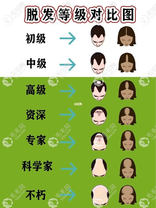 头顶头发稀疏等级表