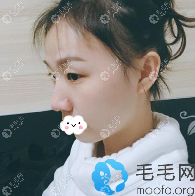 上海华美黄兴勇发际线移植术后半年效果图