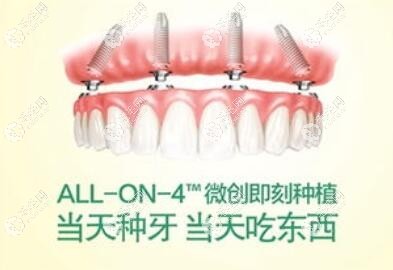 allon4/6即刻负重种植牙是什么意思