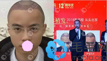 植发后第四天照片