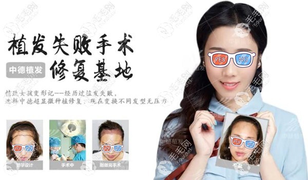 北京中德植发失败修复实例