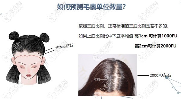 如何預(yù)測毛囊數(shù)量