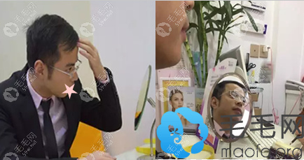 合肥丽人整形医院植发医生方蜜头发种植手术前面诊
