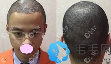 毛发移植后第七天恢复情况