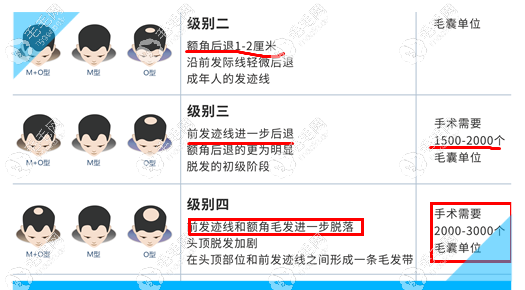 遺傳的m型發(fā)際線植發(fā)單位數(shù)量