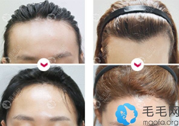 韩国FORHAIR毛发移植医院植发案例