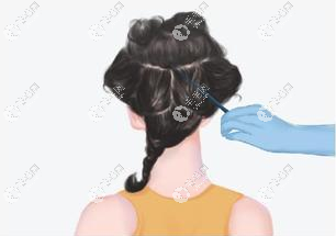 植发危害大吗为什么很多人不植发