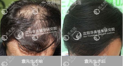 沈陽華美植發(fā)醫(yī)院頭發(fā)稀疏加密案例效果