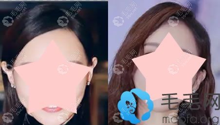 头发稀少可以通过改变发型来掩饰