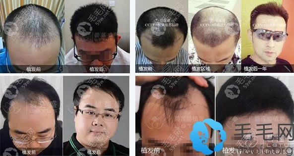 北京碧蓮盛植發(fā)效果能保持多久