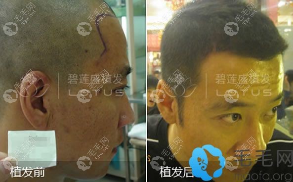 北京碧蓮盛植發(fā)效果圖