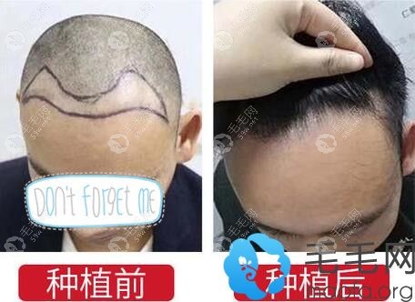 沈阳华美植发效果展示