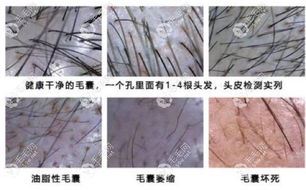 判斷毛囊的健康情況