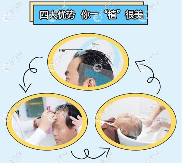 乐山达芬奇植发优势