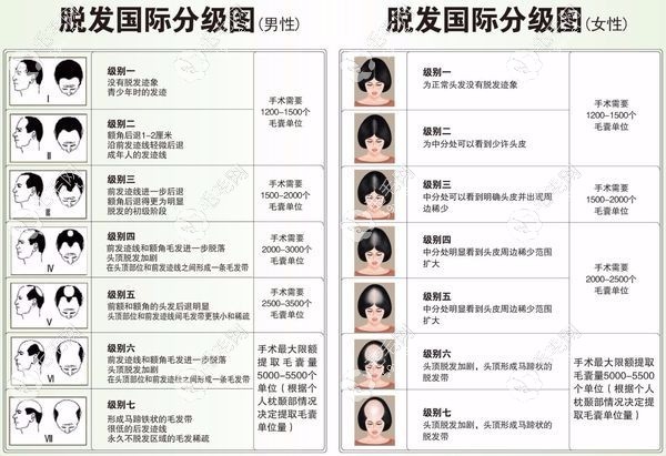 脱发1-7级程度图片