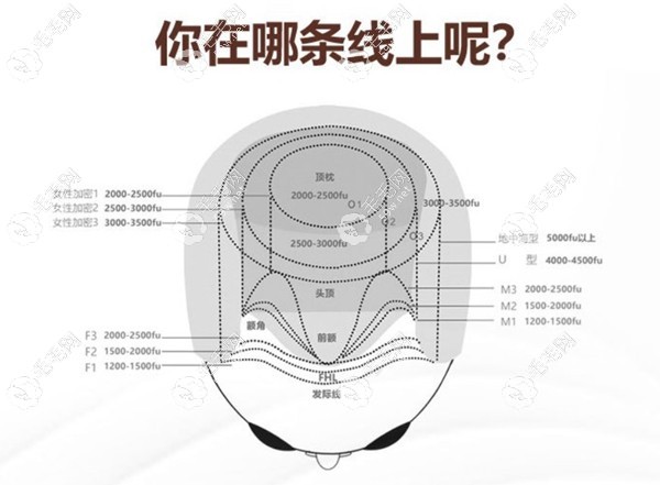 七级脱发还能植发吗59w.net