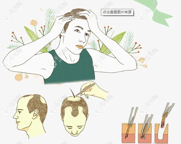 不剃发植发
