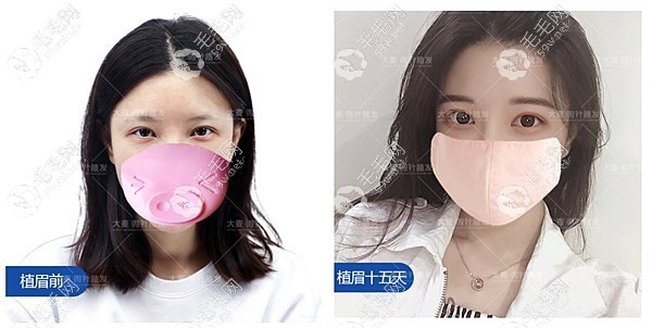 长沙大麦微针植眉效果图