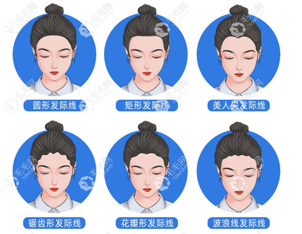 西安科美妍植发发际线类型