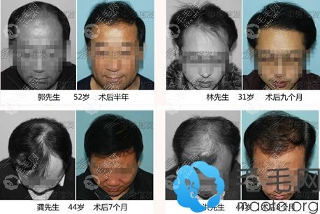 北京中德植发真实案例图