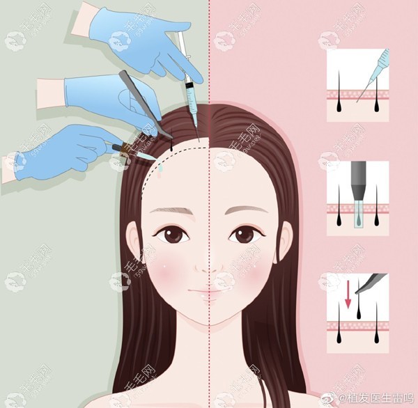 女性植发的价格一般是多少？